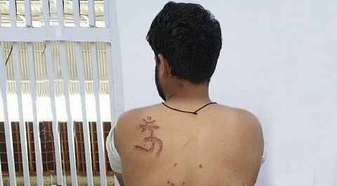 Muslim inmate in Tihar jail burn imprinted with OM symbol, , Delhi court orders Enquiry