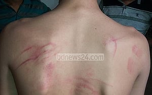 শিক্ষার্থীকে মারধর, ফর্সা হওয়ায় ‘দাগ বেশি’