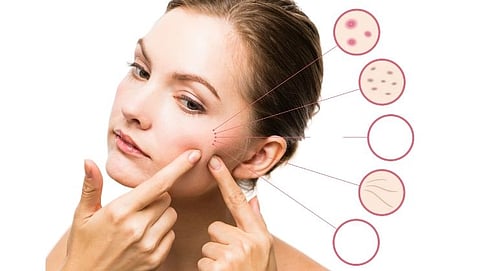 Beauty Tips: prevent acne