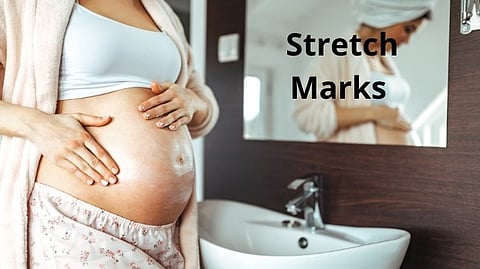 Stretch Marks 