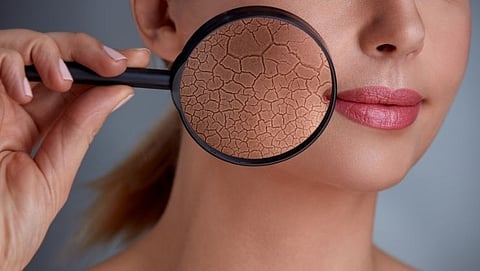 Winter Dry Skin Remedies