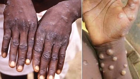 Monkeypox Virus