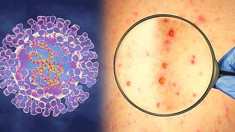 Monkeypox Virus in Goa