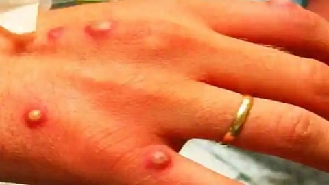 Monkeypox Virus News