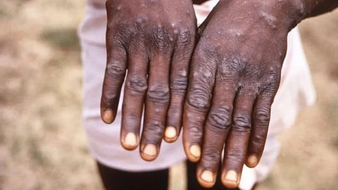 Monkeypox Virus 