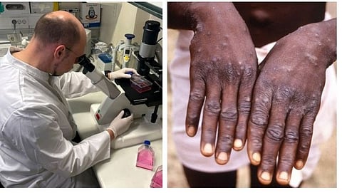 Monkey Pox
