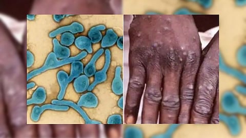 WHO fears an outbreak of Ebola virus?