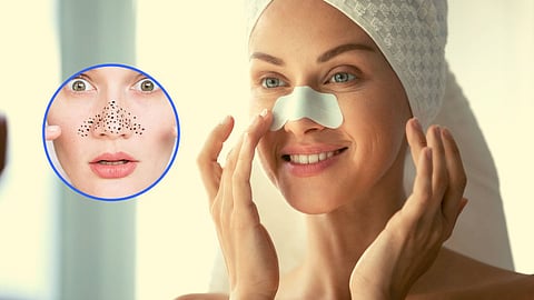 Remedy for Blackheads at Home 