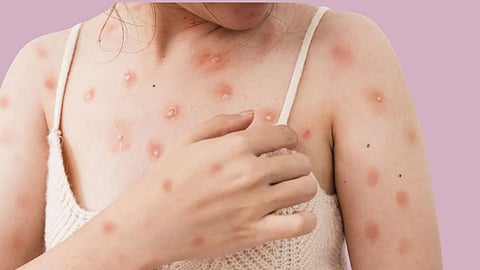 Monkeypox Virus