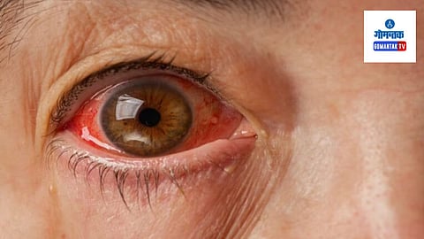 Eye Flu