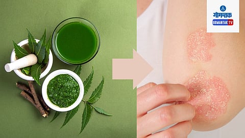 Neem For Skin Disease