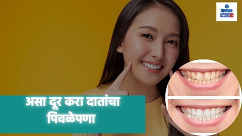 Cause Of Yellow Teeth