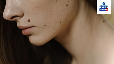 Mole On Body