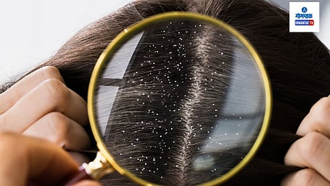 Home Remedy for Dandruff: आज आम्ही तुम्हाला डैंड्रफवर कायमचा तोडगा सुचवणार आहोत, त्यानंतर तुम्हाला काहीही डैंड्रफची समस्या जाणवणार नाही
