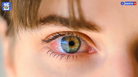 Conjunctivitis Symptoms And Prevention