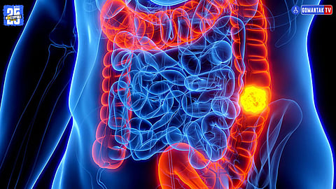 Colon Cancer