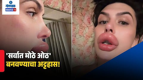 Viral Lip Injection Video