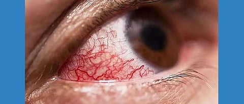 Mucormycosis.jpg