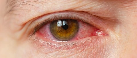 mucormycosis