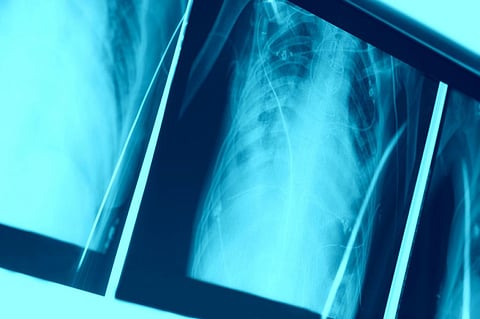 Globally, TB is today the number one infectious killer (Credit: iStock) 