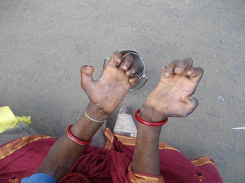 Leprosy remains a challenge in India even though eradication programme was launched way back in 1955 (Credit: iStock) 