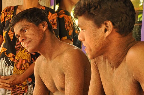 Manikantan and Sujith from Kasaragod suffer from psoriasis due to endosulfan exposure (2010) (Credit: Savvy Soumya Mishra/CSE) 