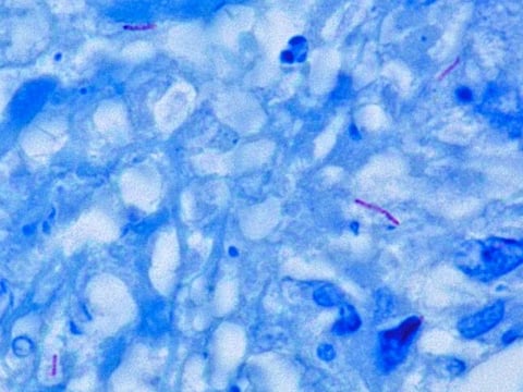 Mycobacterium tuberculosis, the pathogen that causes TB        Credit: Wikimedia Commons