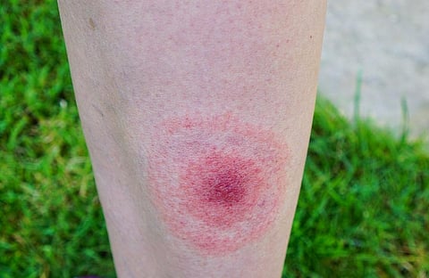 The leg of a person affected with Lyme Disease, transmitted through the bites of ticks. The disease, however, does not appear to be transmissible between people, by other animals, or through food and is hence classified as a Non-Communicable Disease     Credit: Getty Images