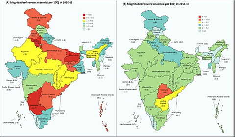 भारत में गंभीर एनीमिया के मामले घटे, पिछड़े राज्यों में सुधरे हालात 
