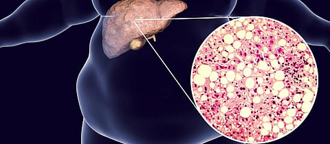 Obesity is one of the risk factors for non-alcoholic fatty liver disease. Kateryna Kon/Shutterstock.com