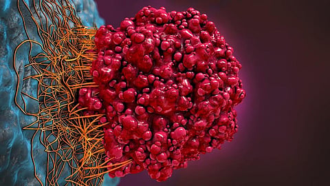  Researchers decode why brain tumours are hard to treat