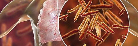Chloroquine with TB antibiotic may reduce drug resistance