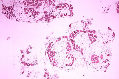 A breakthrough for a rare genetic disorder