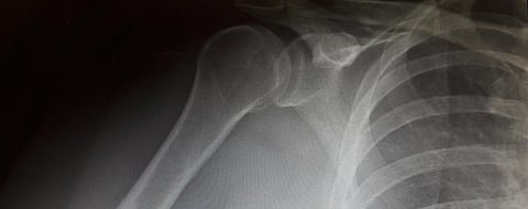 This new protein may help diabetes patients with fractures
