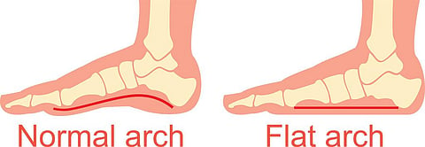 What would happen if humans had flat feet?