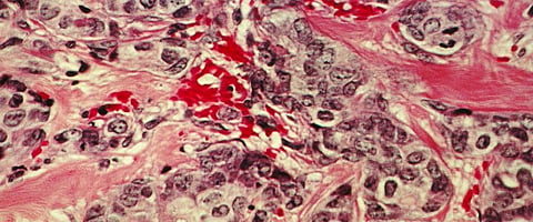 Tobacco behind more than a quarter of India’s cancer cases