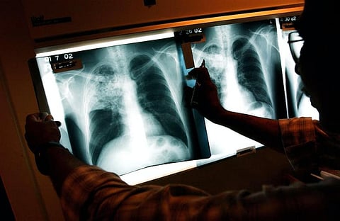 First ever national survey shows the extent of South Africa’s TB problem