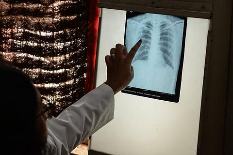How COVID-19 threatens to undo years of progress in TB control