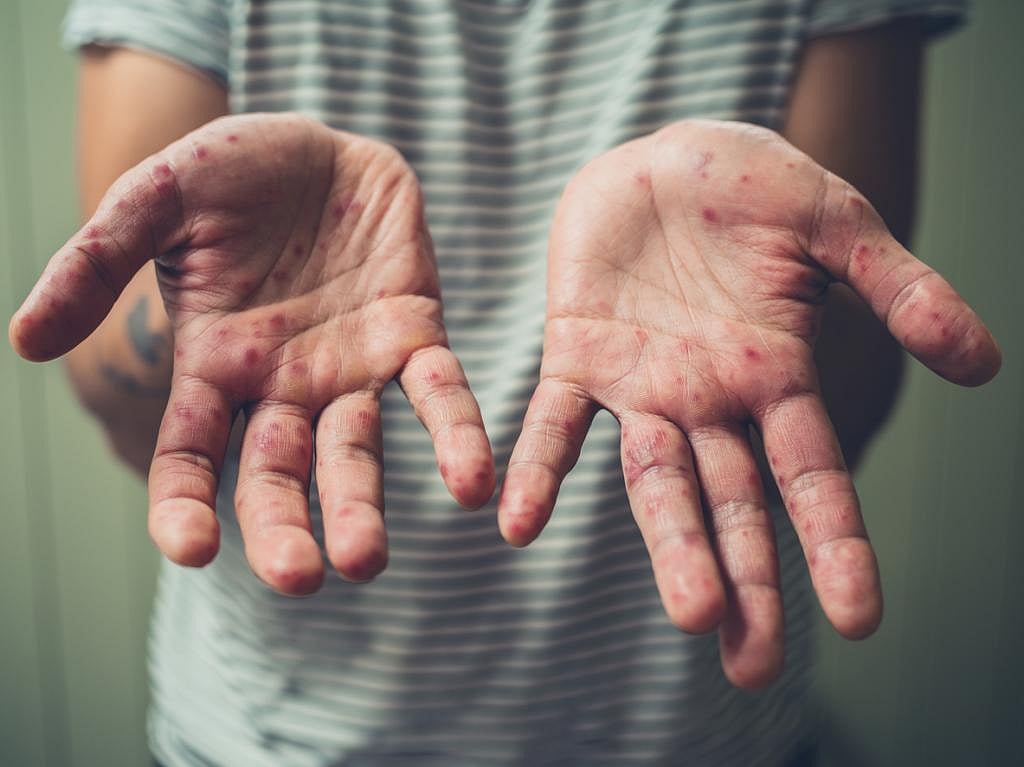 Measles cases double in 1st 2 months of 2022: What does this warn us of