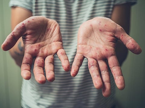 Measles cases double in 1st 2 months of 2022: What does this warn us of