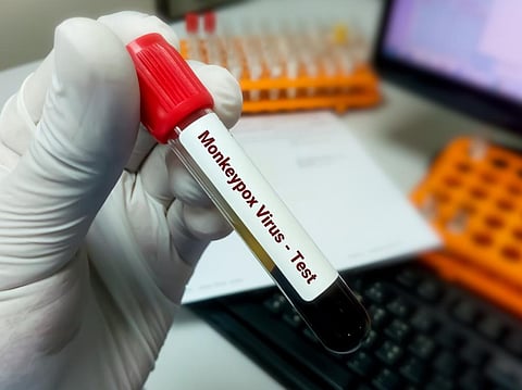 Monkeypox virus found in semen. Is it enough to call it STI? 