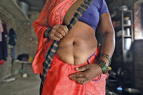 Hysterectomy  is often touted as a permanent solution to benign gynaecological problems such as excessive menstrual bleeding (Photograph: Vikas Choudhary)