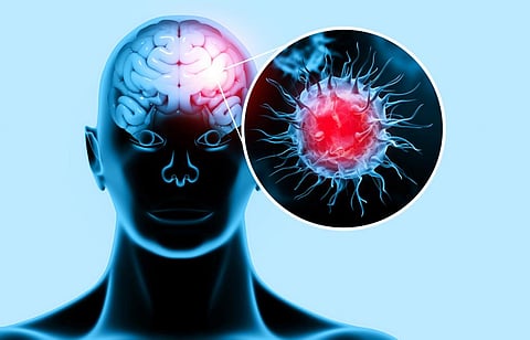 Brain fog after COVID-19? Study shows severe infection can trigger expression of ‘old age’ genes