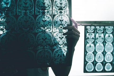 Though this genetic form of Alzheimer’s only affects around 1% of the population, it provides useful information on how the disease progresses. Photo: Atthapon Raksthaput/ Shutterstock