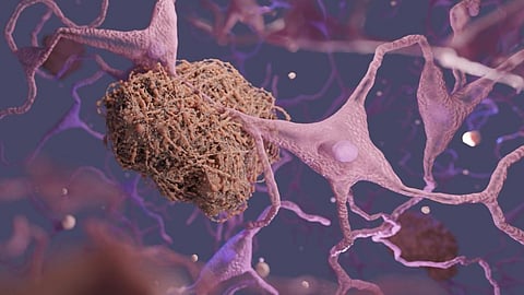 New Alzheimer’s drug: What you need to know about donanemab’s promising trial results