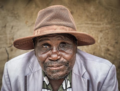Trachoma causes about 1.4 per cent of all blindness worldwide. Photo for representation: iStock