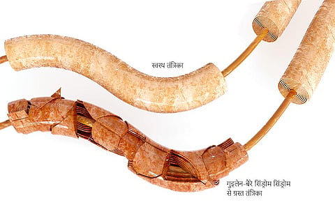 जानिए क्या है गुइलेन-बैरे सिंड्रोम, जिसके चलते पेरू में लगाना पड़ा स्वास्थ्य आपातकाल