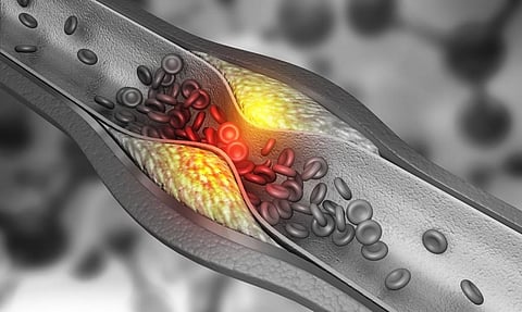 An iStock illustration showing an artery blocked by plaque
