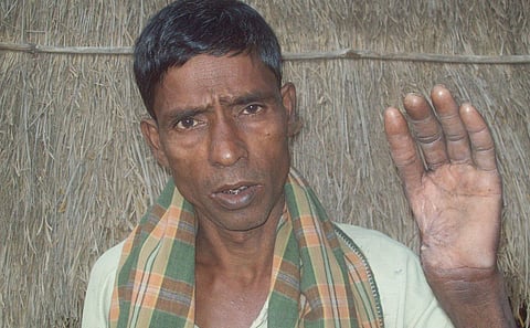 Kabindra Dalei, who lost his thumb in a saltwater crocodile attack. 