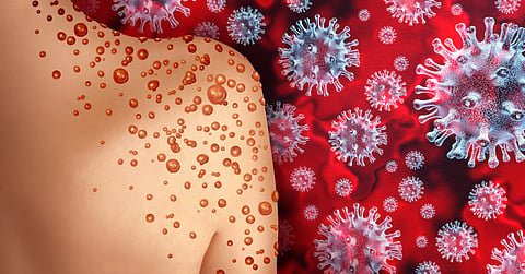 The infection is similar to smallpox which was effectively eradicated in 1980, but mpox has continued to make headlines in central and west Africa.

